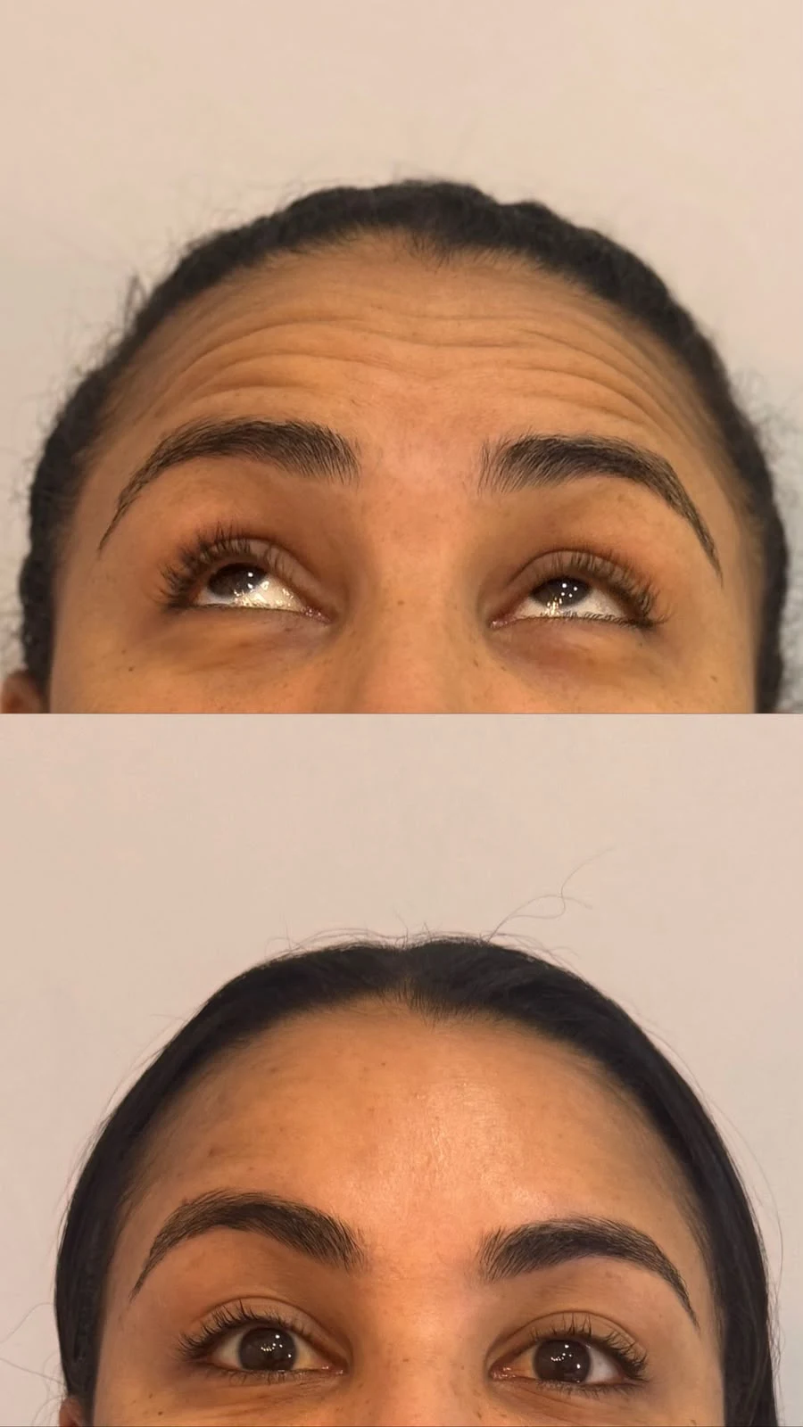 Antes e depois Botox 2: Depois